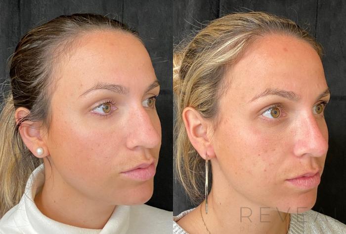 Before & After Rhinoplasty Case 548 View #5 View in San Jose, CA