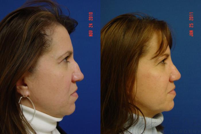 Before & After Rhinoplasty Case 56 View #1 View in San Jose, CA