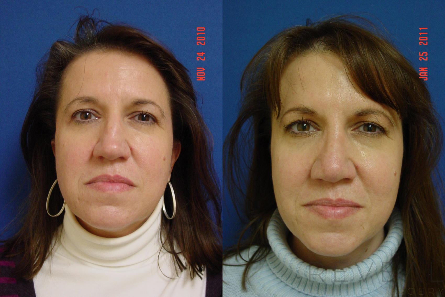 Before & After Rhinoplasty Case 56 View #2 View in San Jose, CA