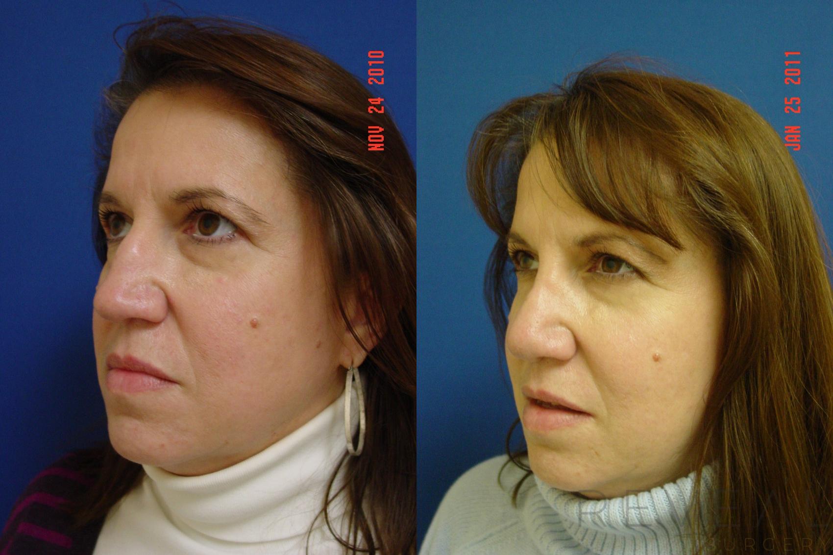 Before & After Rhinoplasty Case 56 View #3 View in San Jose, CA