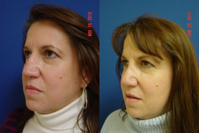 Before & After Rhinoplasty Case 56 View #3 View in San Jose, CA