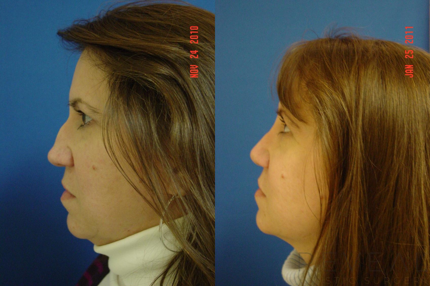 Before & After Rhinoplasty Case 56 View #4 View in San Jose, CA