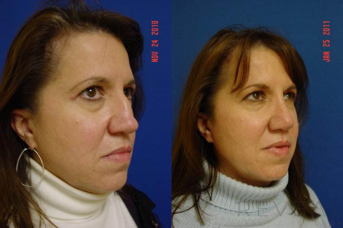 Before & After Rhinoplasty Case 56 View #5 View in San Jose, CA