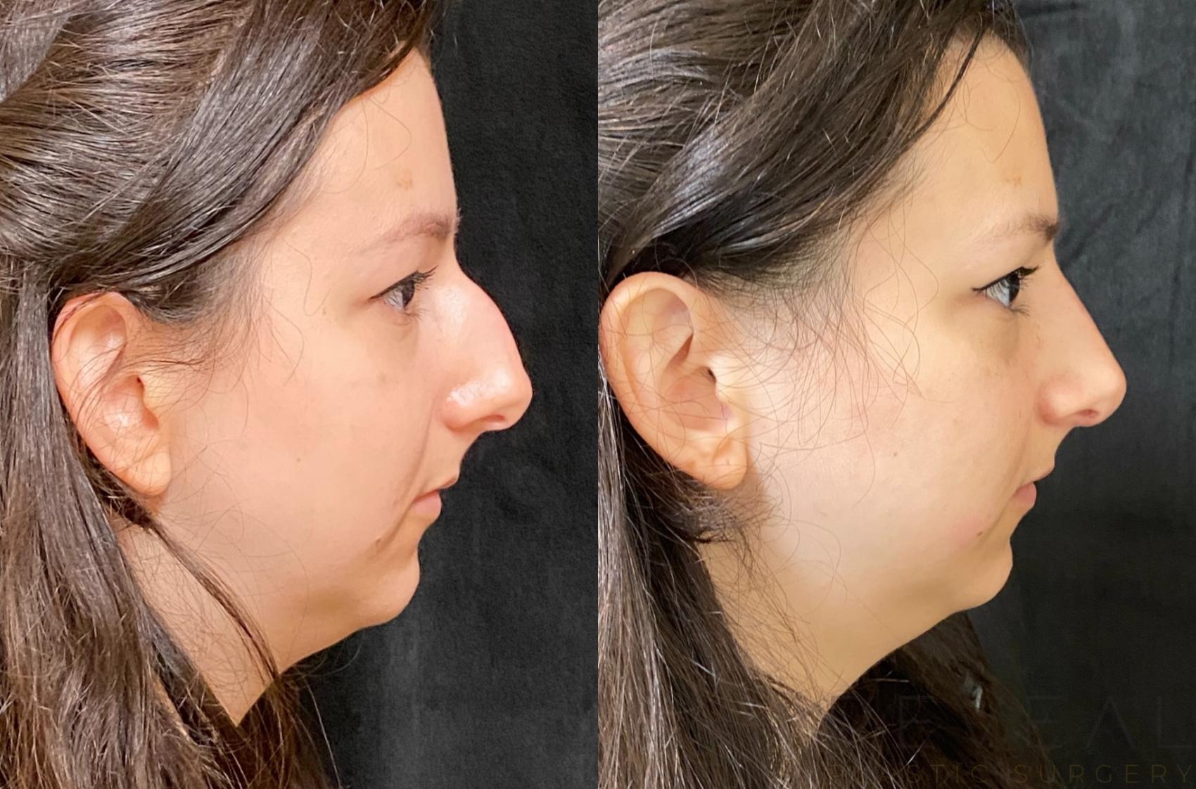 Before & After Rhinoplasty Case 583 View #1 View in San Jose, CA