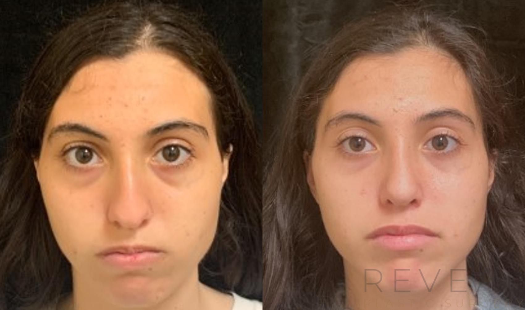 Before & After Rhinoplasty Case 589 View #1 View in San Jose, CA