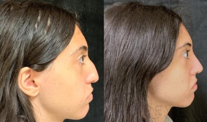 Before & After Rhinoplasty Case 589 View #2 View in San Jose, CA