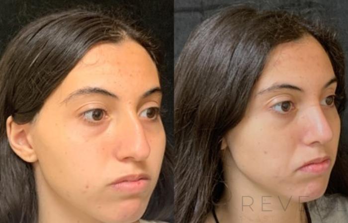Before & After Rhinoplasty Case 589 View #3 View in San Jose, CA