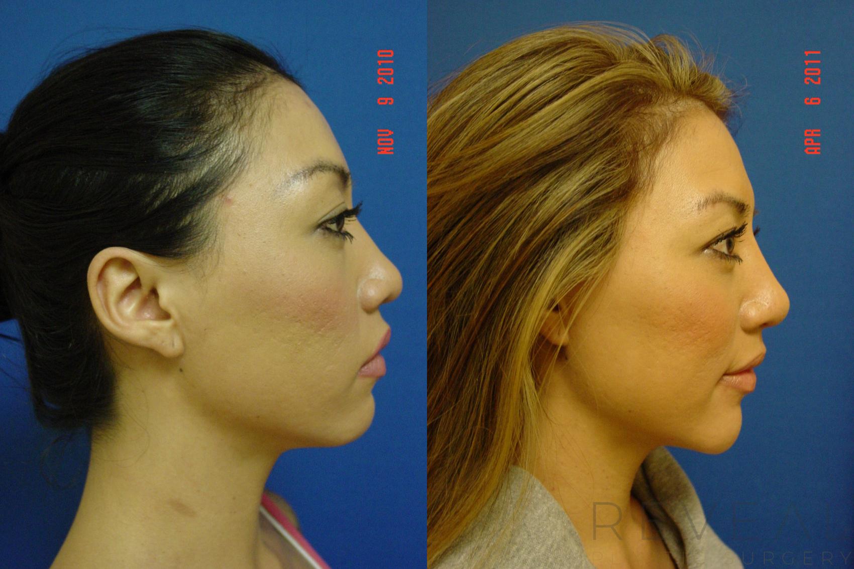Before & After Chin Augmentation Case 65 View #1 View in San Jose, CA