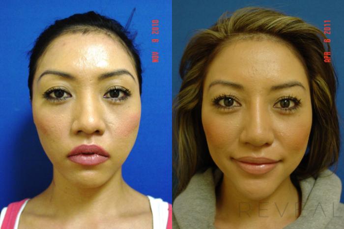 Before & After Rhinoplasty Case 65 View #2 View in San Jose, CA