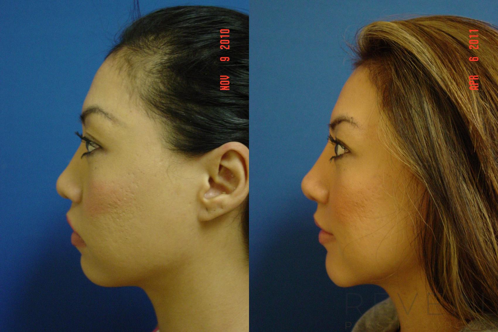 Before & After Rhinoplasty Case 65 View #3 View in San Jose, CA