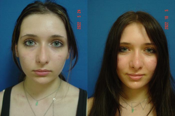 Before & After Rhinoplasty Case 670 Front View in San Jose, CA
