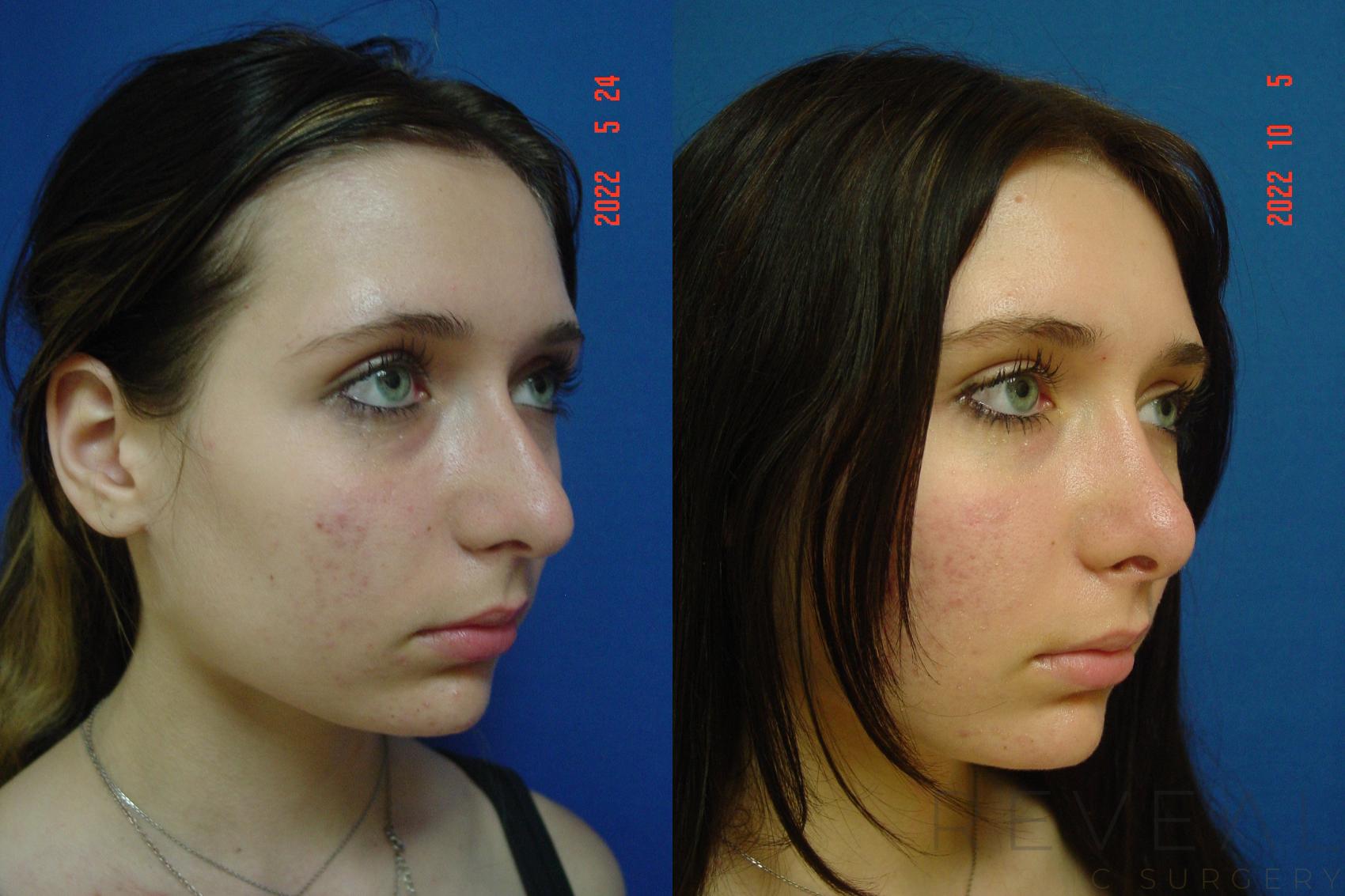 Before & After Rhinoplasty Case 670 Left Oblique View in San Jose, CA