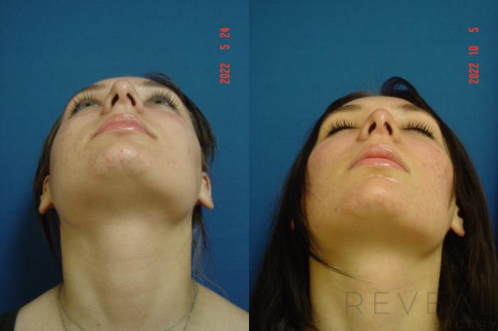Before & After Rhinoplasty Case 670 Looking up View in San Jose, CA