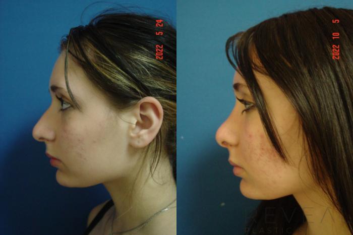 Before & After Rhinoplasty Case 670 Right Side View in San Jose, CA