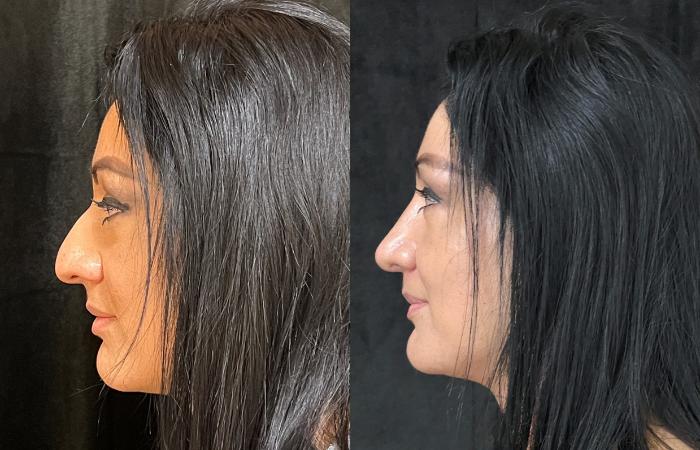 Before & After Rhinoplasty Case 686 Right Oblique View in San Jose, CA