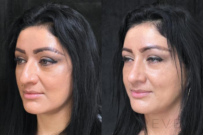 Before & After Rhinoplasty Case 686 Right Side View in San Jose, CA