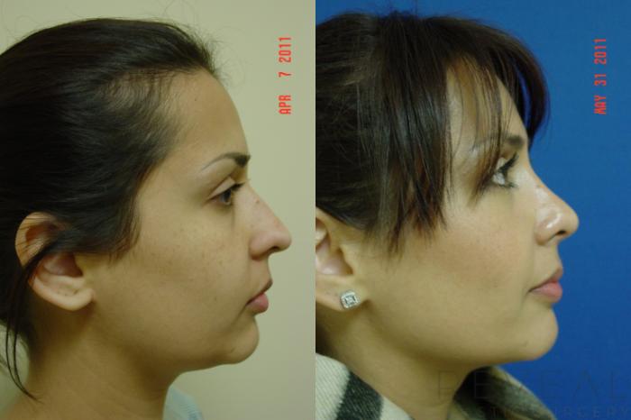 Before & After Rhinoplasty Case 69 View #1 View in San Jose, CA