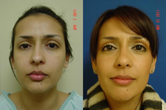 Before & After Rhinoplasty Case 69 View #2 View in San Jose, CA