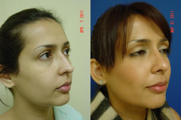 Before & After Rhinoplasty Case 69 View #3 View in San Jose, CA