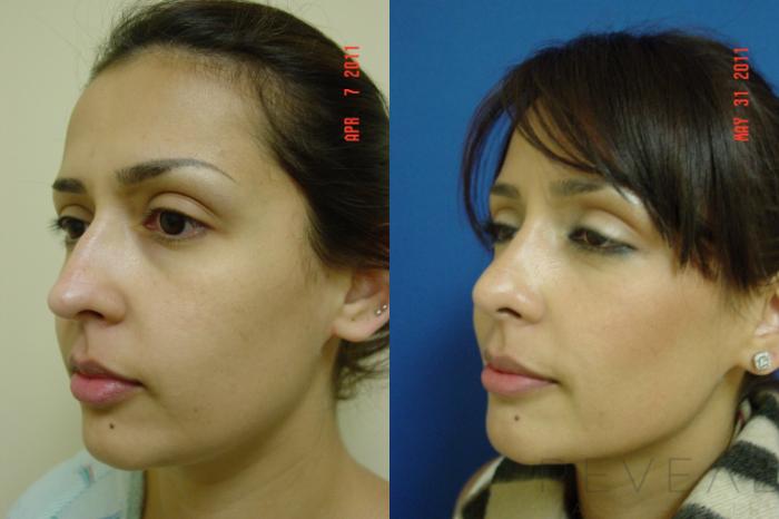 Before & After Rhinoplasty Case 69 View #4 View in San Jose, CA