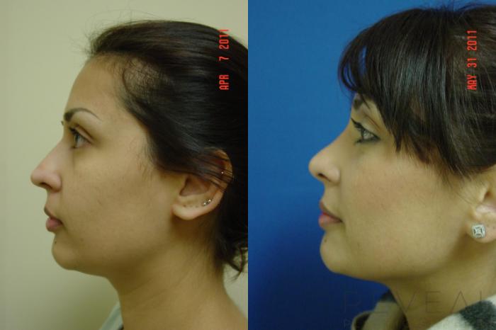 Before & After Rhinoplasty Case 69 View #5 View in San Jose, CA