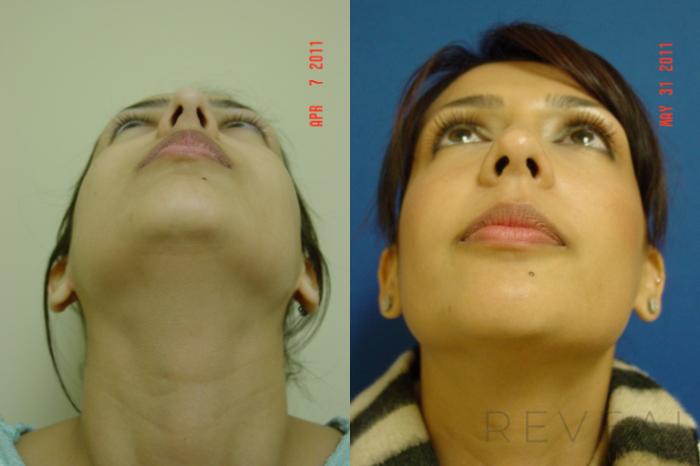 Before & After Rhinoplasty Case 69 View #6 View in San Jose, CA
