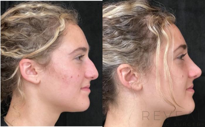Before & After Rhinoplasty Case 695 Front View in San Jose, CA