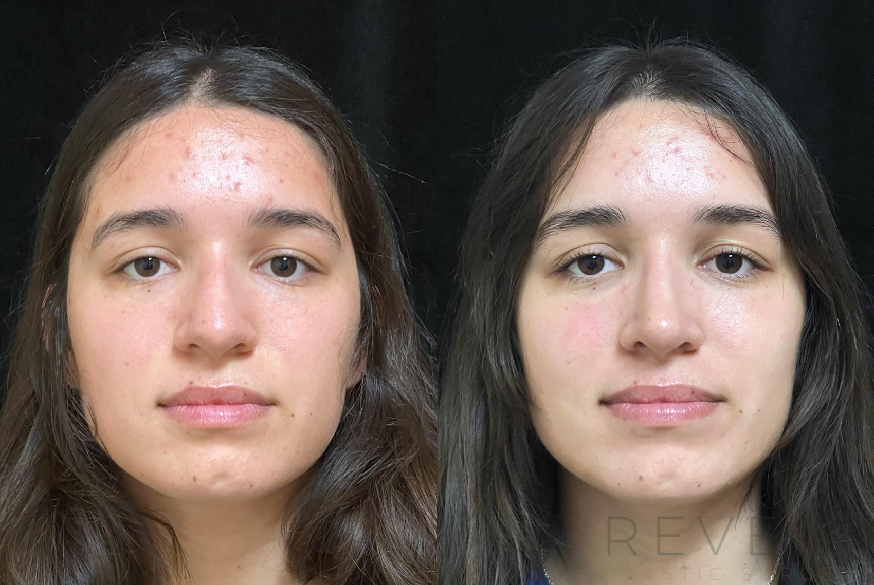 Before & After Rhinoplasty Case 727 Front View in San Jose, CA