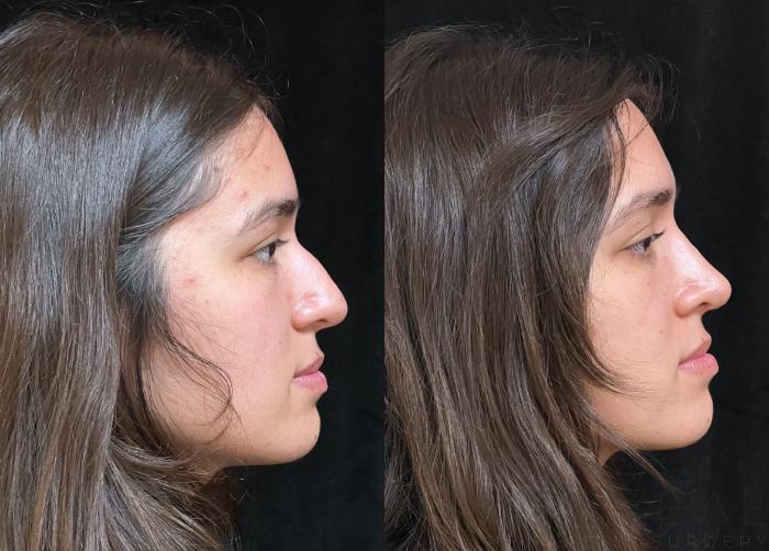 Before & After Rhinoplasty Case 727 Left Oblique View in San Jose, CA