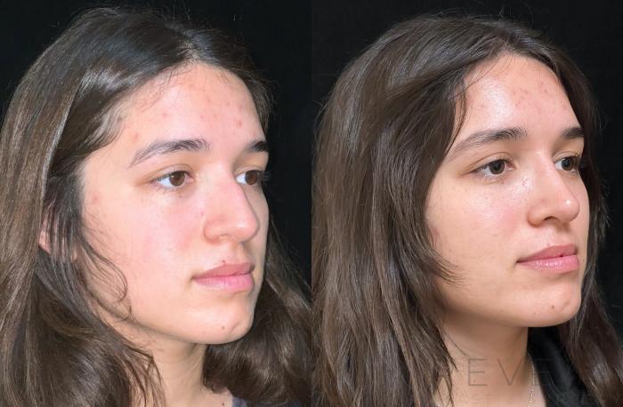 Before & After Rhinoplasty Case 727 Left Side View in San Jose, CA