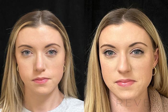 Before & After Rhinoplasty Case 742 Front View in San Jose, CA