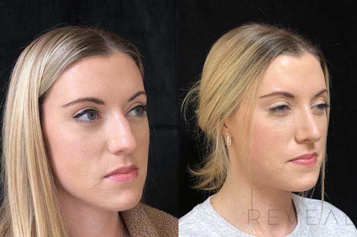 Before & After Rhinoplasty Case 742 Left Oblique View in San Jose, CA