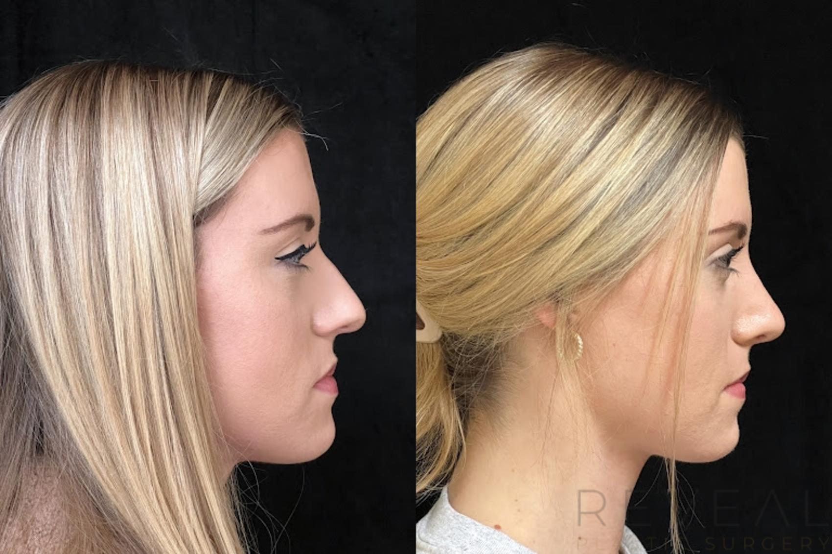 Before & After Rhinoplasty Case 742 Left Side View in San Jose, CA