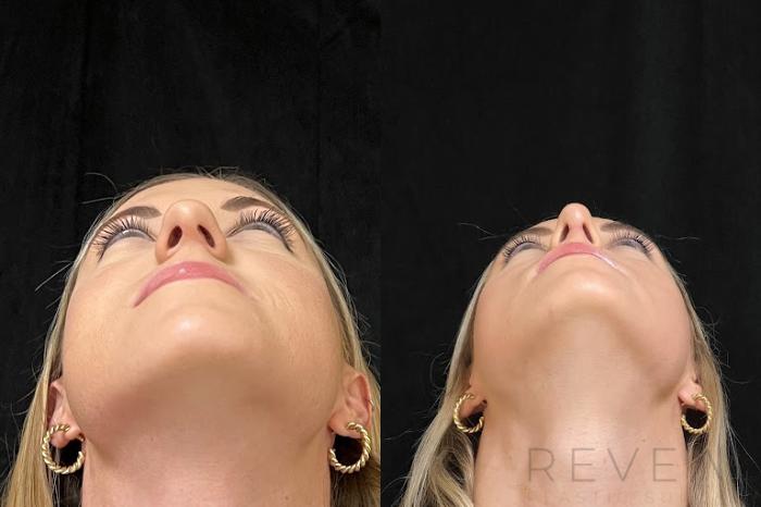 Before & After Rhinoplasty Case 742 Right Side View in San Jose, CA