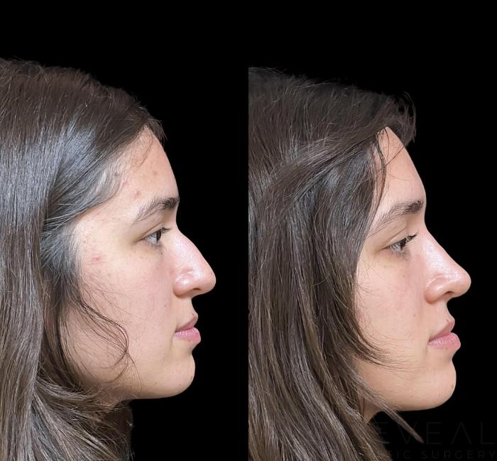 Before & After Rhinoplasty Case 748 Left Oblique View in San Jose, CA