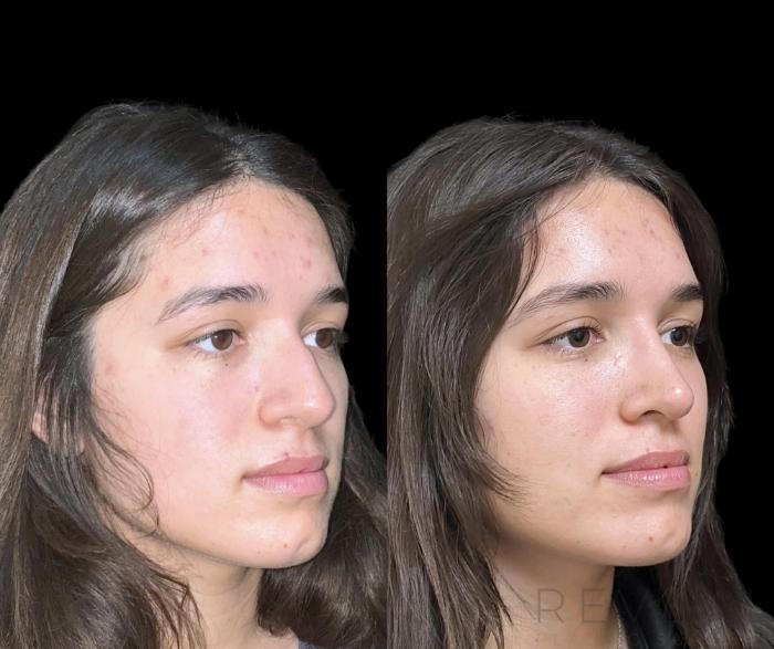 Before & After Rhinoplasty Case 748 Left Side View in San Jose, CA
