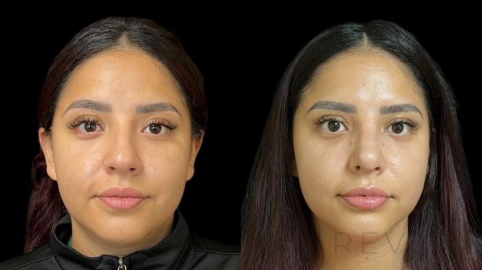 Before & After Rhinoplasty Case 781 Front View in San Jose, CA