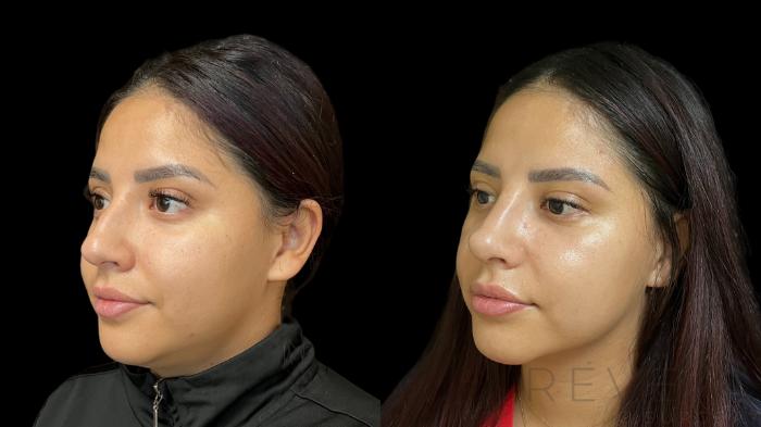 Before & After Rhinoplasty Case 781 Left Oblique View in San Jose, CA
