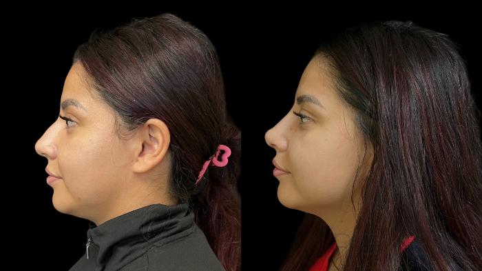 Before & After Rhinoplasty Case 781 Left Side View in San Jose, CA