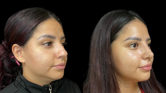 Before & After Rhinoplasty Case 781 Right Oblique View in San Jose, CA