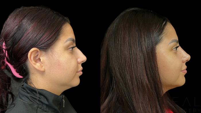 Before & After Rhinoplasty Case 781 Right Side View in San Jose, CA