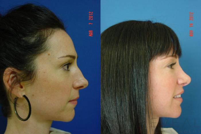 Before & After Rhinoplasty Case 91 View #1 View in San Jose, CA