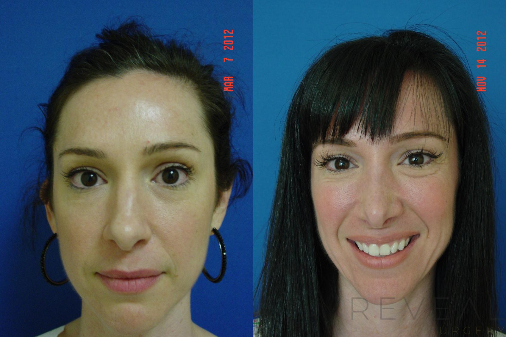 Before & After Rhinoplasty Case 91 View #2 View in San Jose, CA