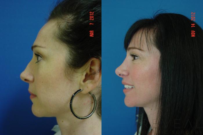 Before & After Rhinoplasty Case 91 View #4 View in San Jose, CA