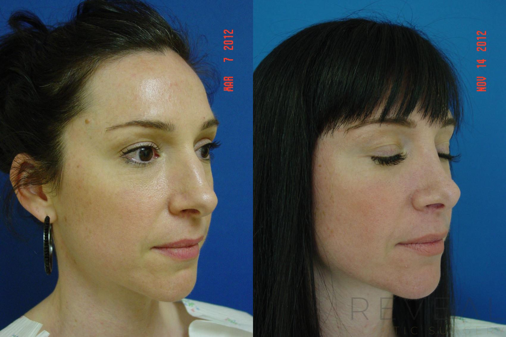 Before & After Rhinoplasty Case 91 View #5 View in San Jose, CA