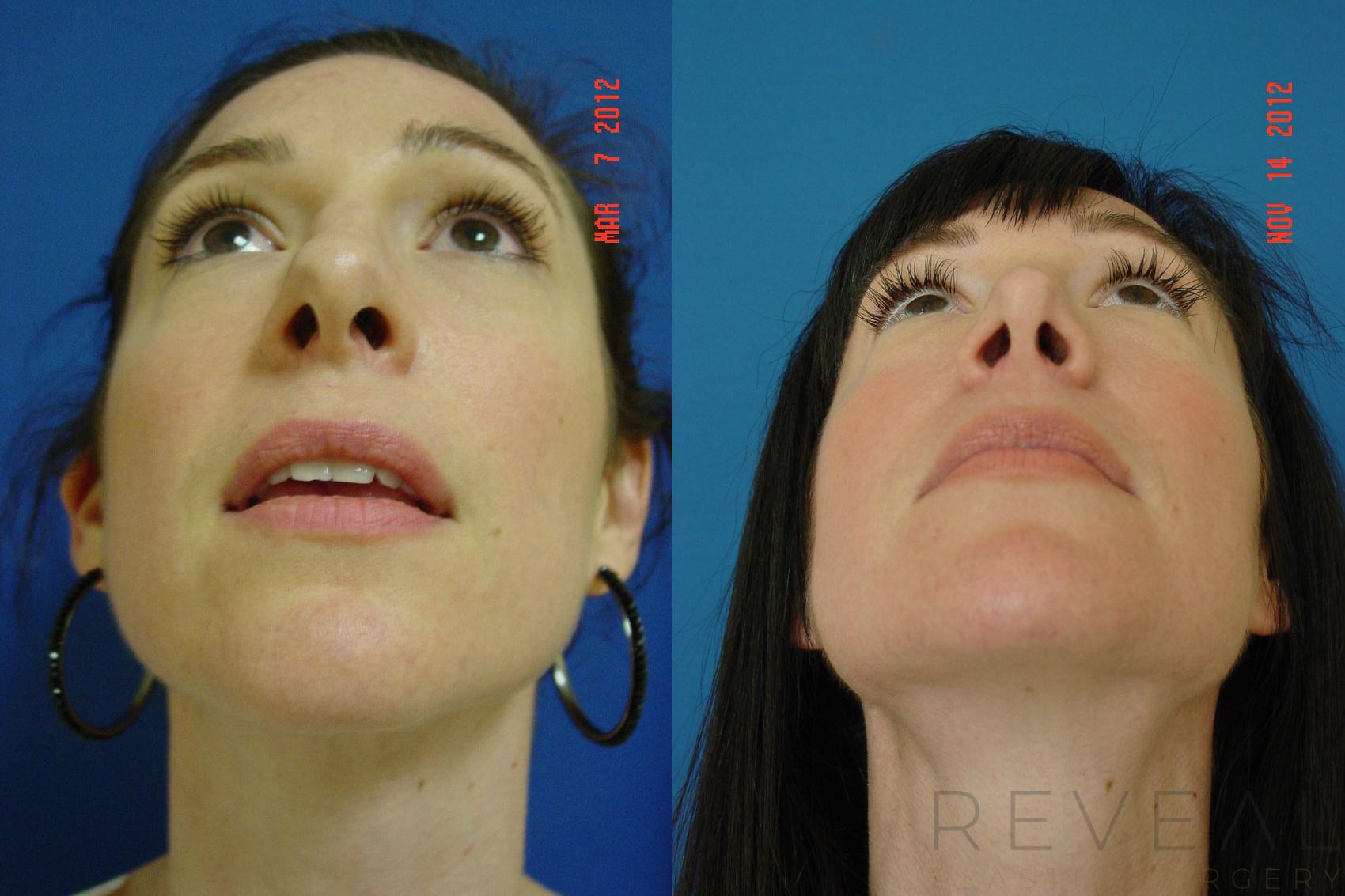 Before & After Rhinoplasty Case 91 View #6 View in San Jose, CA