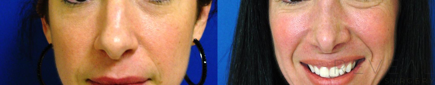 Before & After Rhinoplasty Case 93 View #2 View in San Jose, CA
