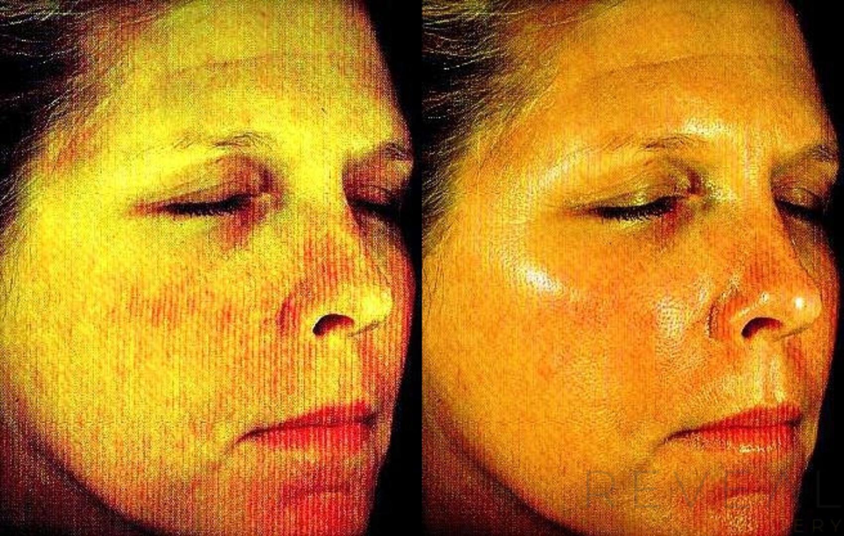 Before & After Peels & Resurfacing Case 108 View #1 View in San Jose, CA