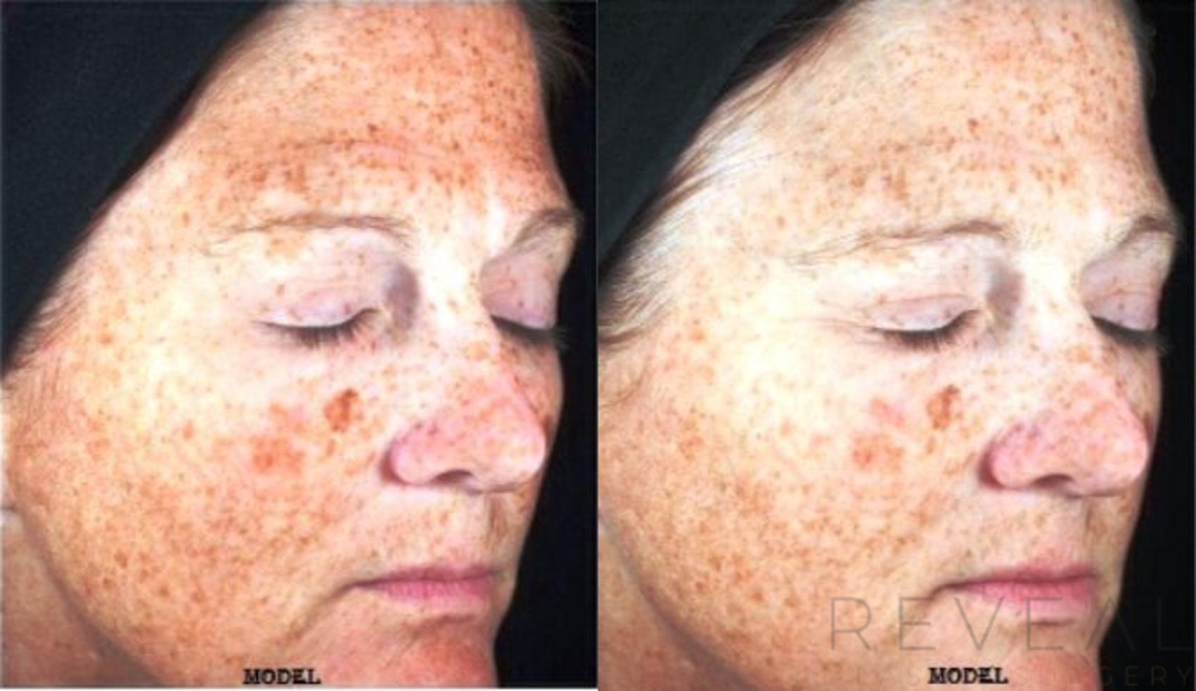 Before & After Skin Care Case 126 View #1 View in San Jose, CA