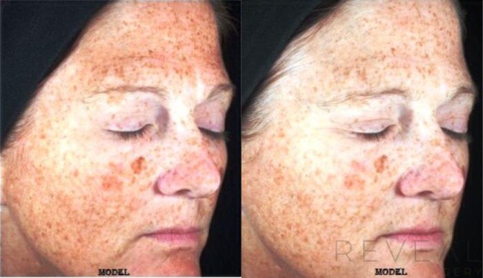 Before & After Skin Care Case 126 View #1 View in San Jose, CA